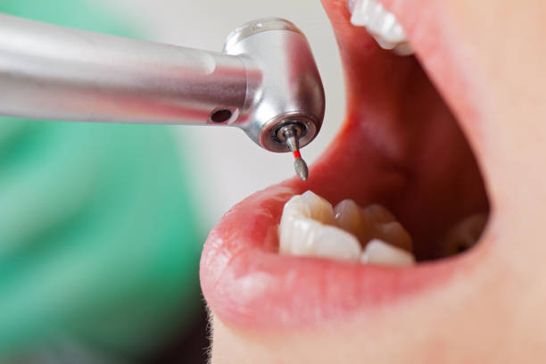 Best Emergency Root Canal Treatment in Lake Jackson, TX